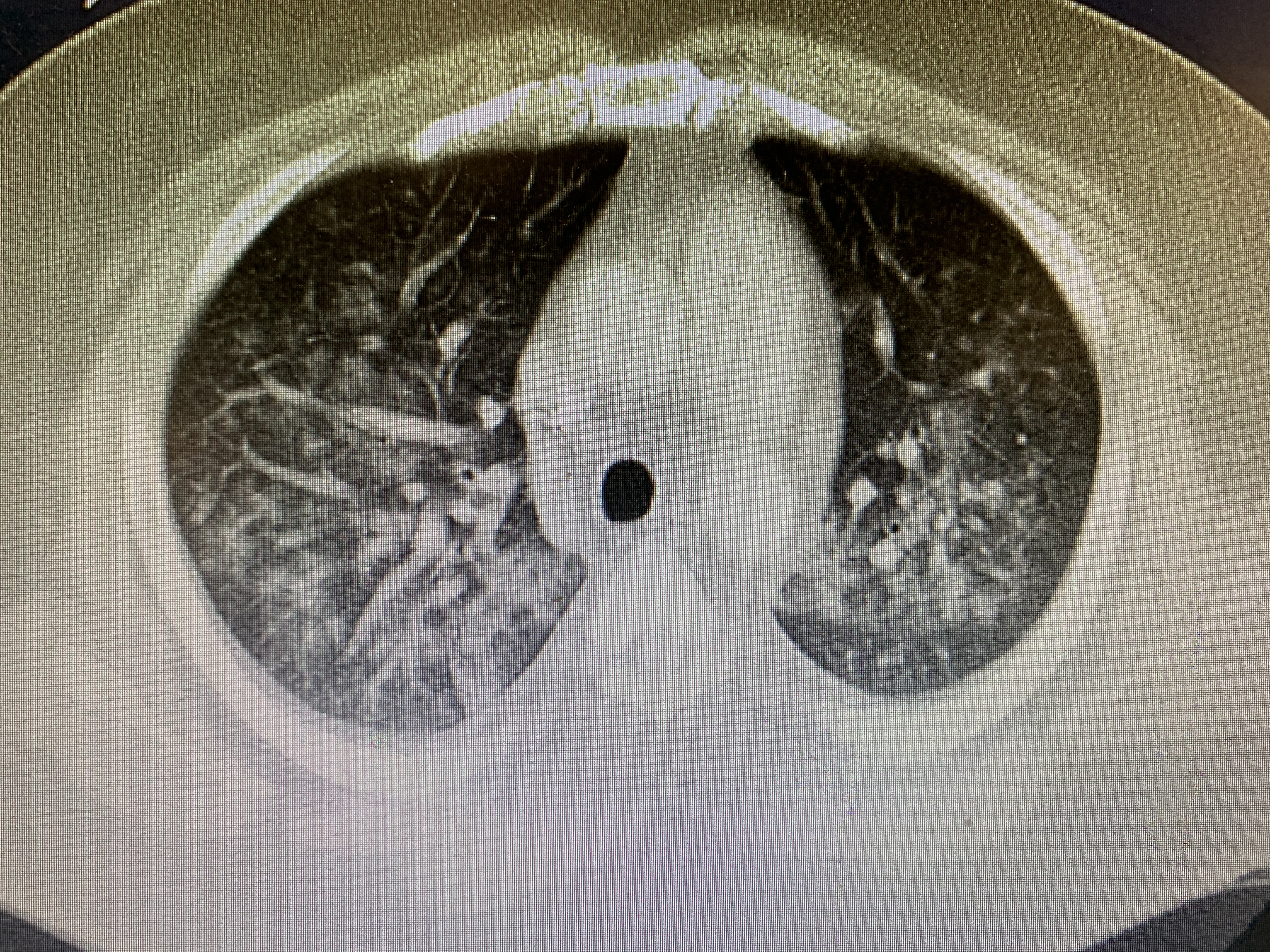 Multifocal Infiltrates Ultrasound Case of the Month – Dec – AOMC FOAMed
