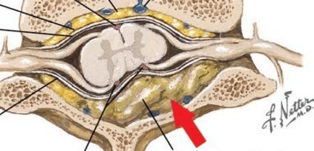 Spinal Epidural Abscess